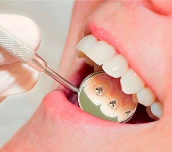 Manejamos diferentes técnicas de ortodoncia invisible con alineadores dentales o con brackets linguales.