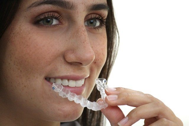 Ortodoncia Invisible Cali, Invisalign, Alineadores Invisibles, brackets transparentes, cerámicos, autoligado, convencionales.