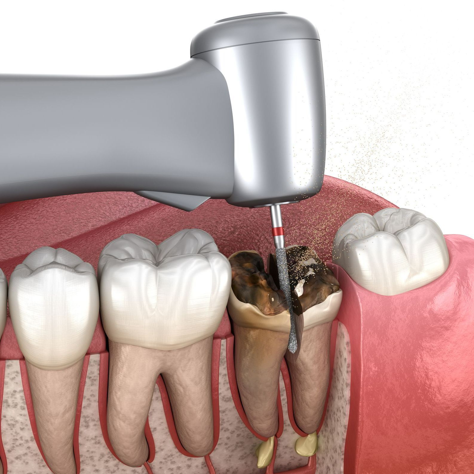 Tooth Extraction — Port Noarlunga, SA — Natural Denture Clinic