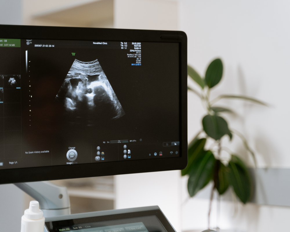 Ultrasound monitor showing a grayscale image, likely of a fetus, in a medical setting.
