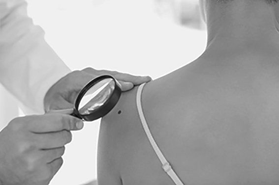 Plastic Surgery Biopsy or Removal Johannesburg