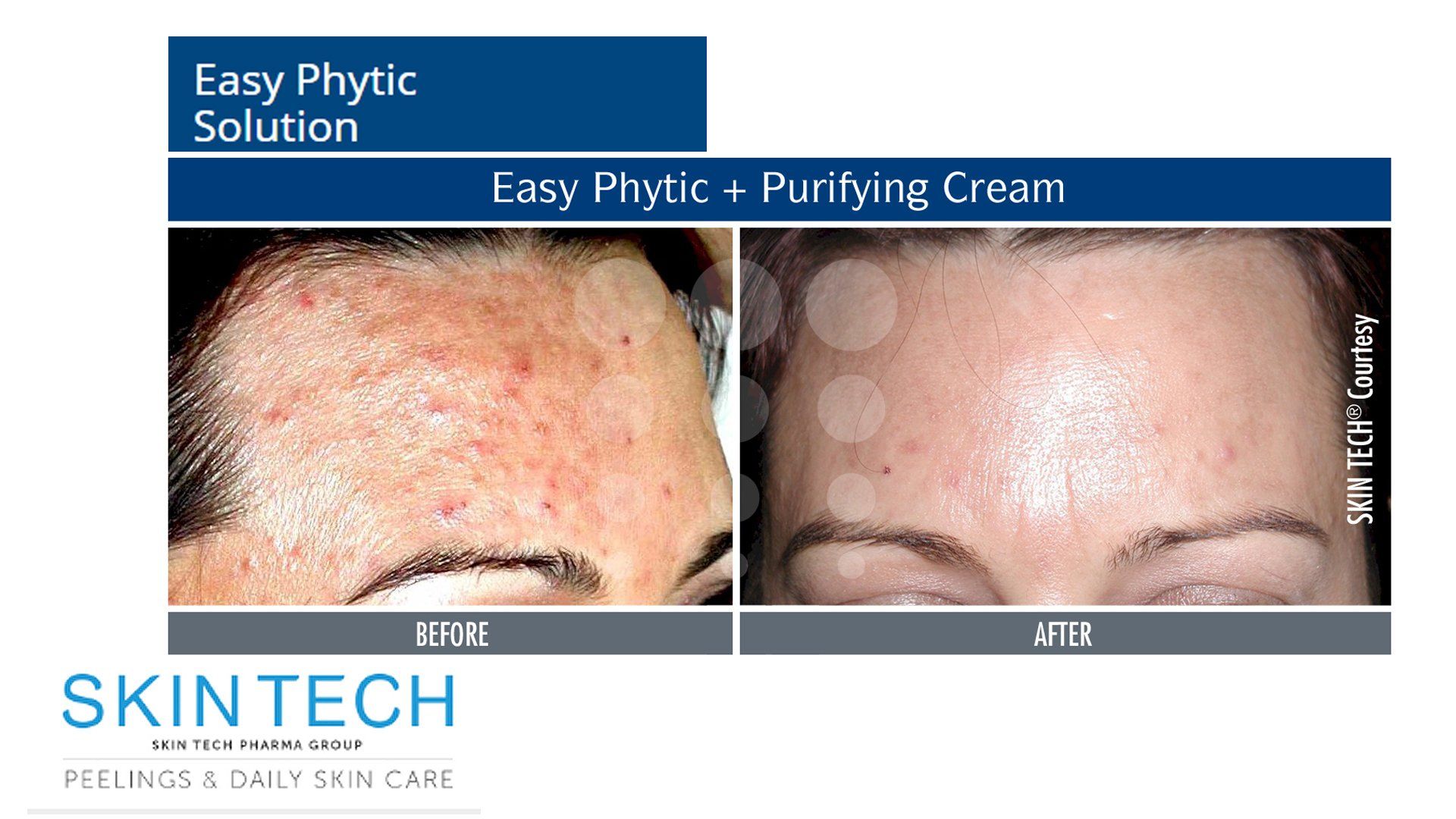 Chemical Peels Johannesburg Dr Anton Brewis