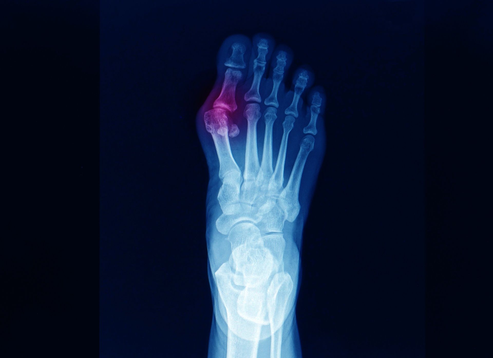 An x-ray of a foot with a red spot on the toe.