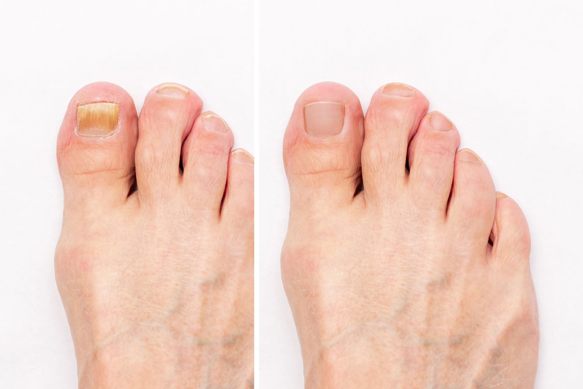 A before and after picture of a person 's toenails.