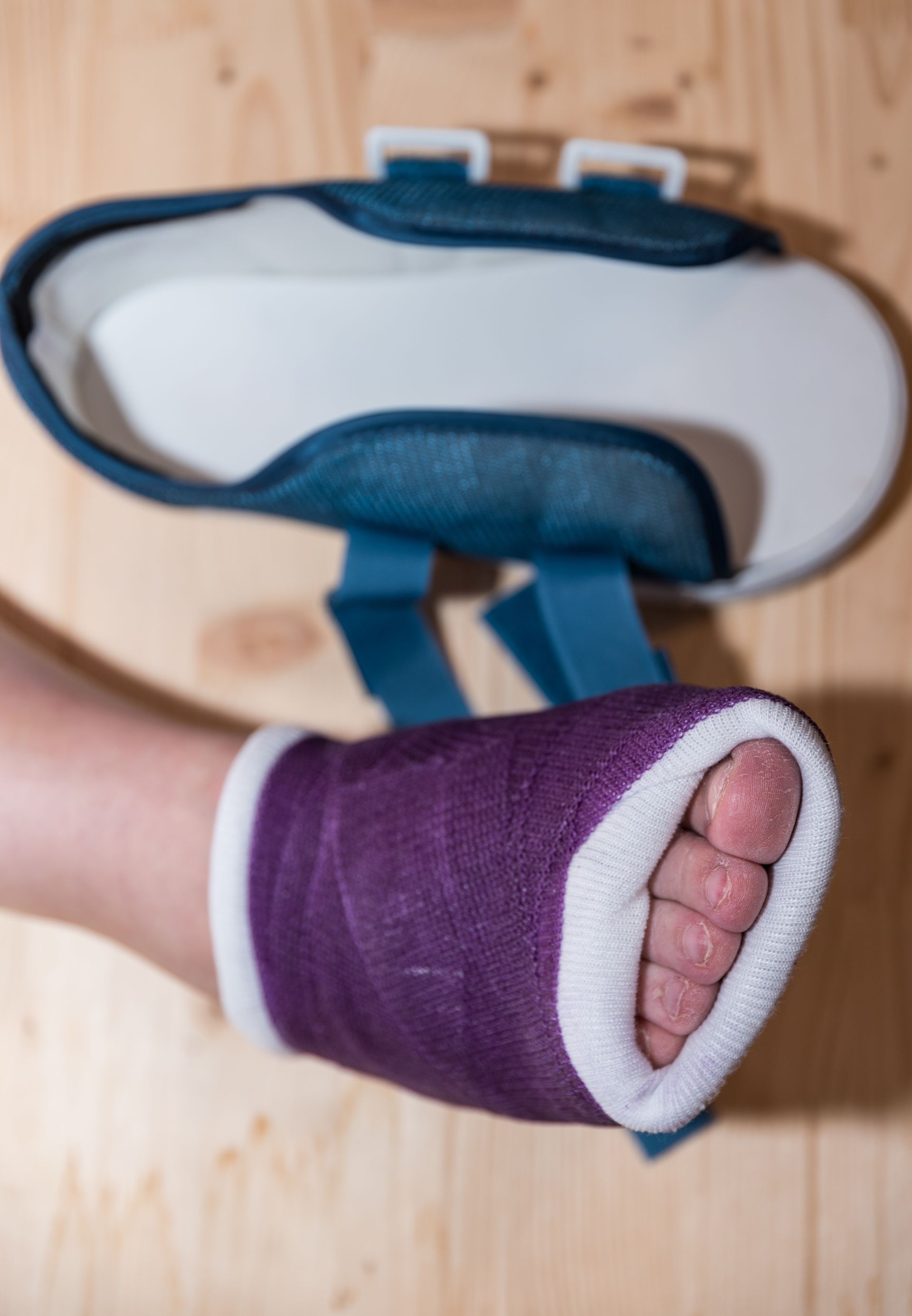 A person with a purple cast on their foot.