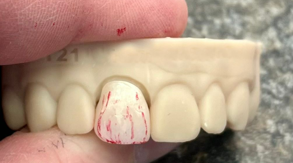 Before tooth crown & bridge restoration