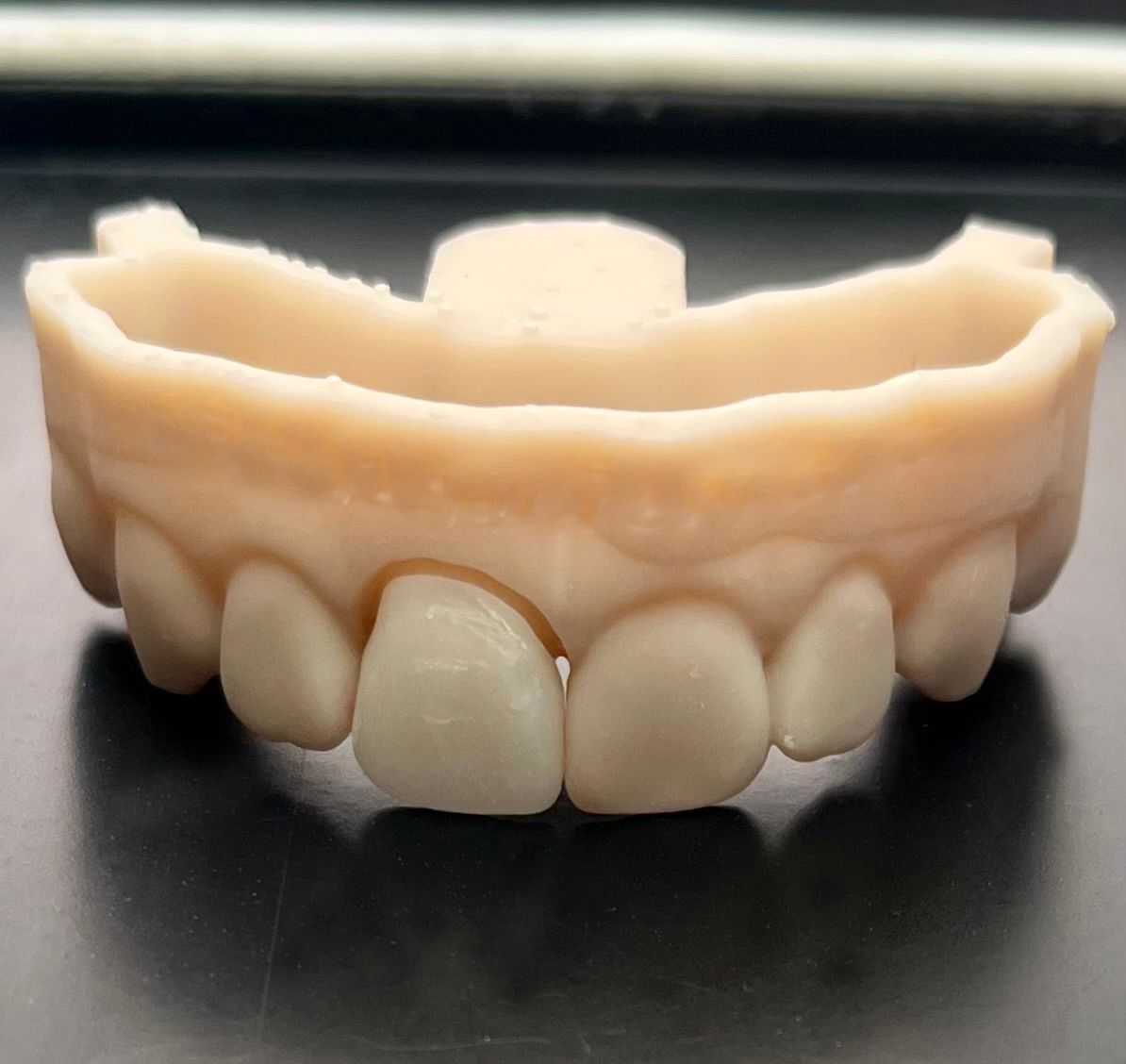 After tooth crown & bridge restoration