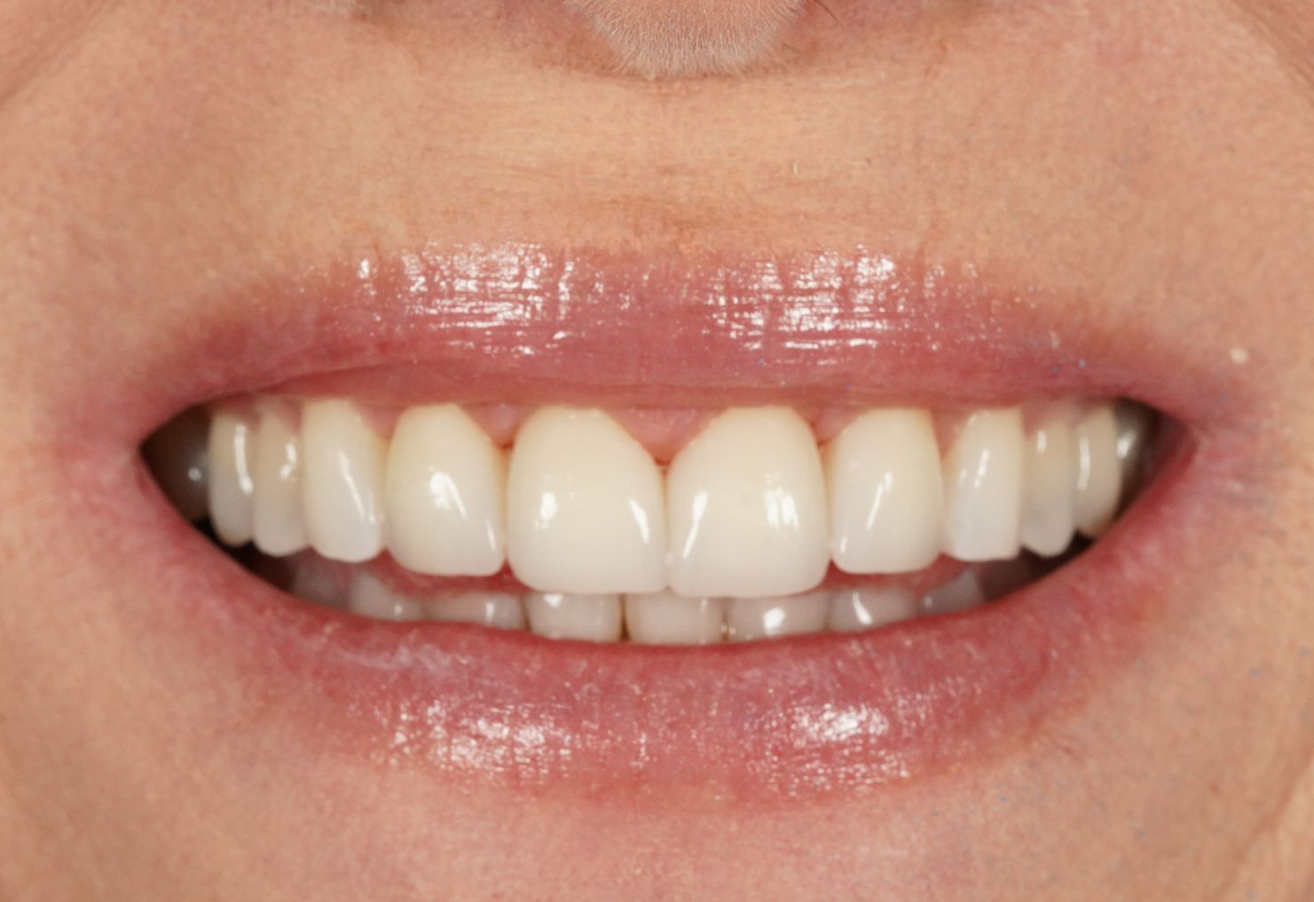 Dental lab crown & bridge restoration services in Rexburg, ID