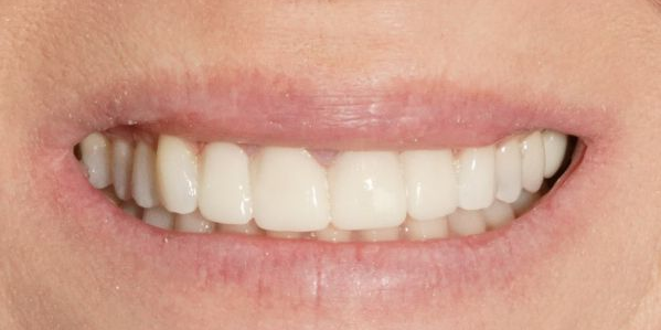 Dental lab services in Rexburg, ID