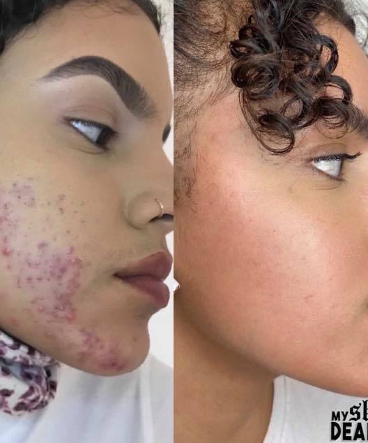 Skin imperfections at Malory at Medispa