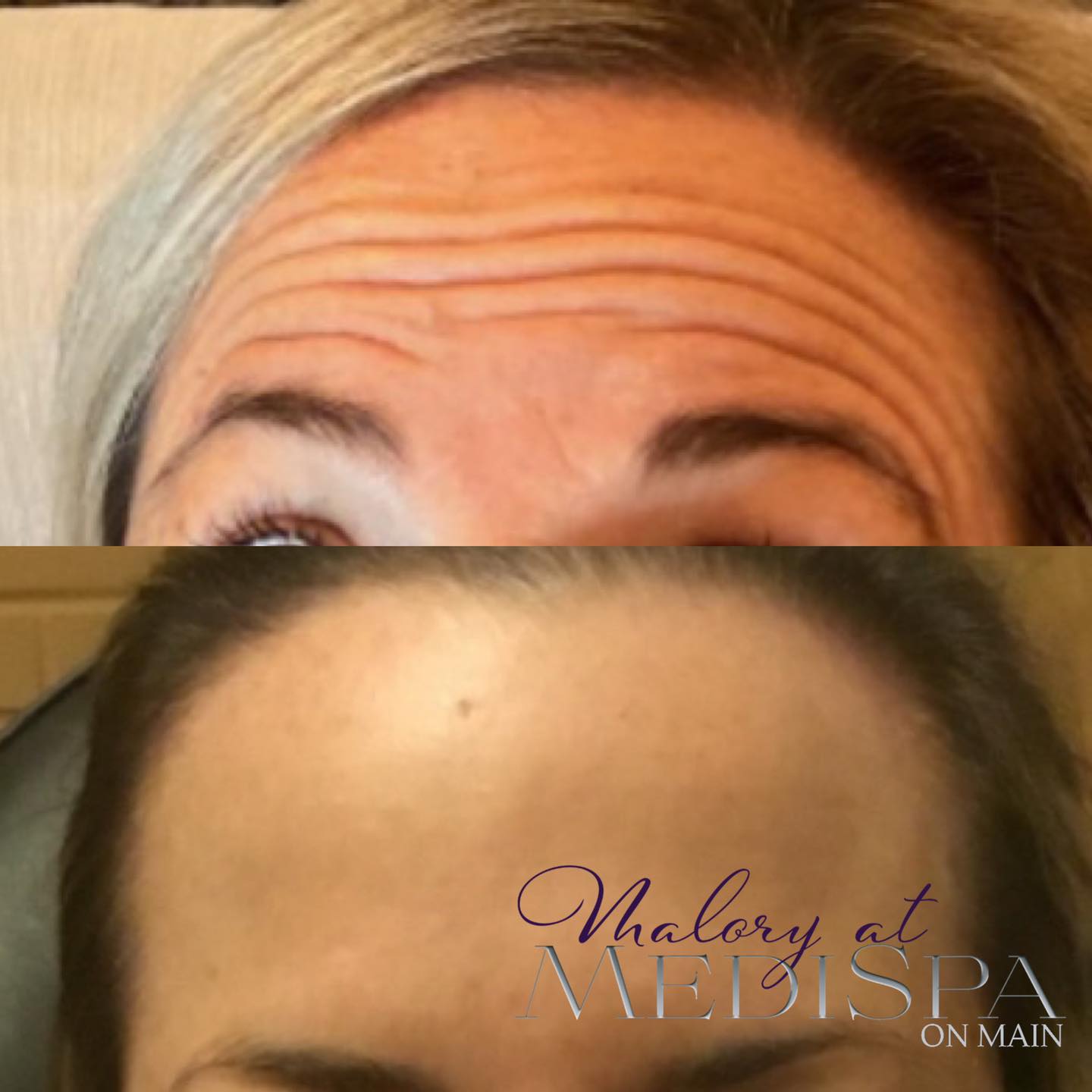 Forehead line solutions