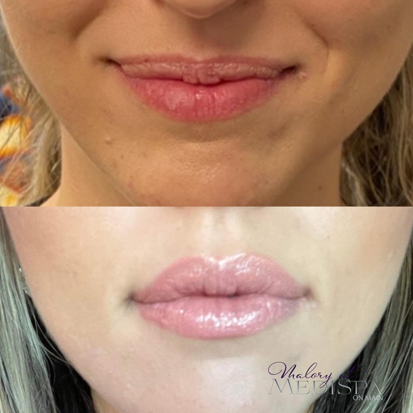 Lip fillers at Malory at Medispa