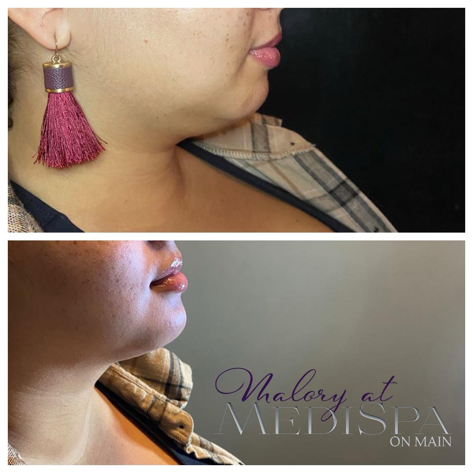Double chin correction at Malory at Medispa