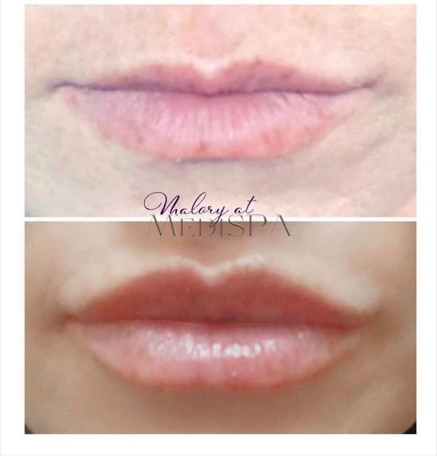 Lip fillers el dorado