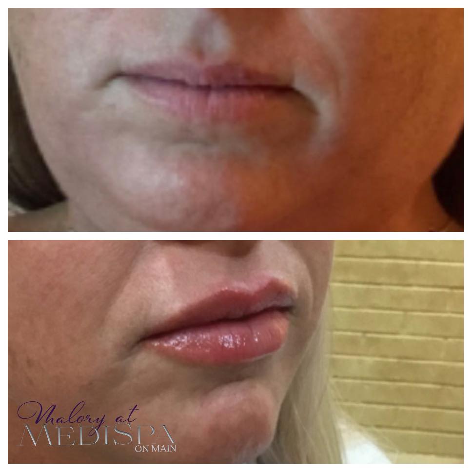 Botox at Malory at Medispa