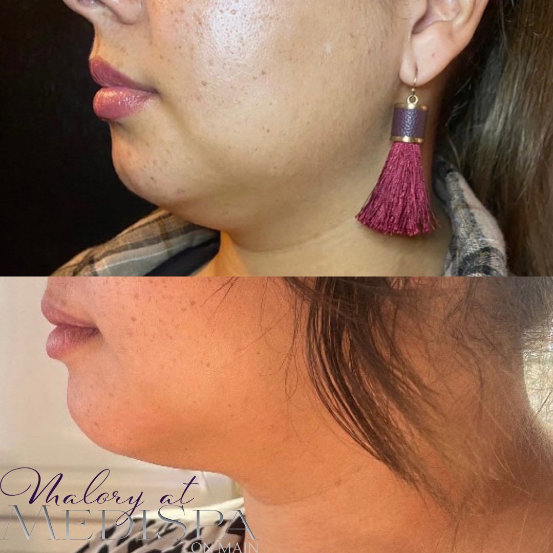 Double chin at Malory at Medispa