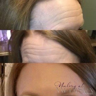 Forehead line treatment