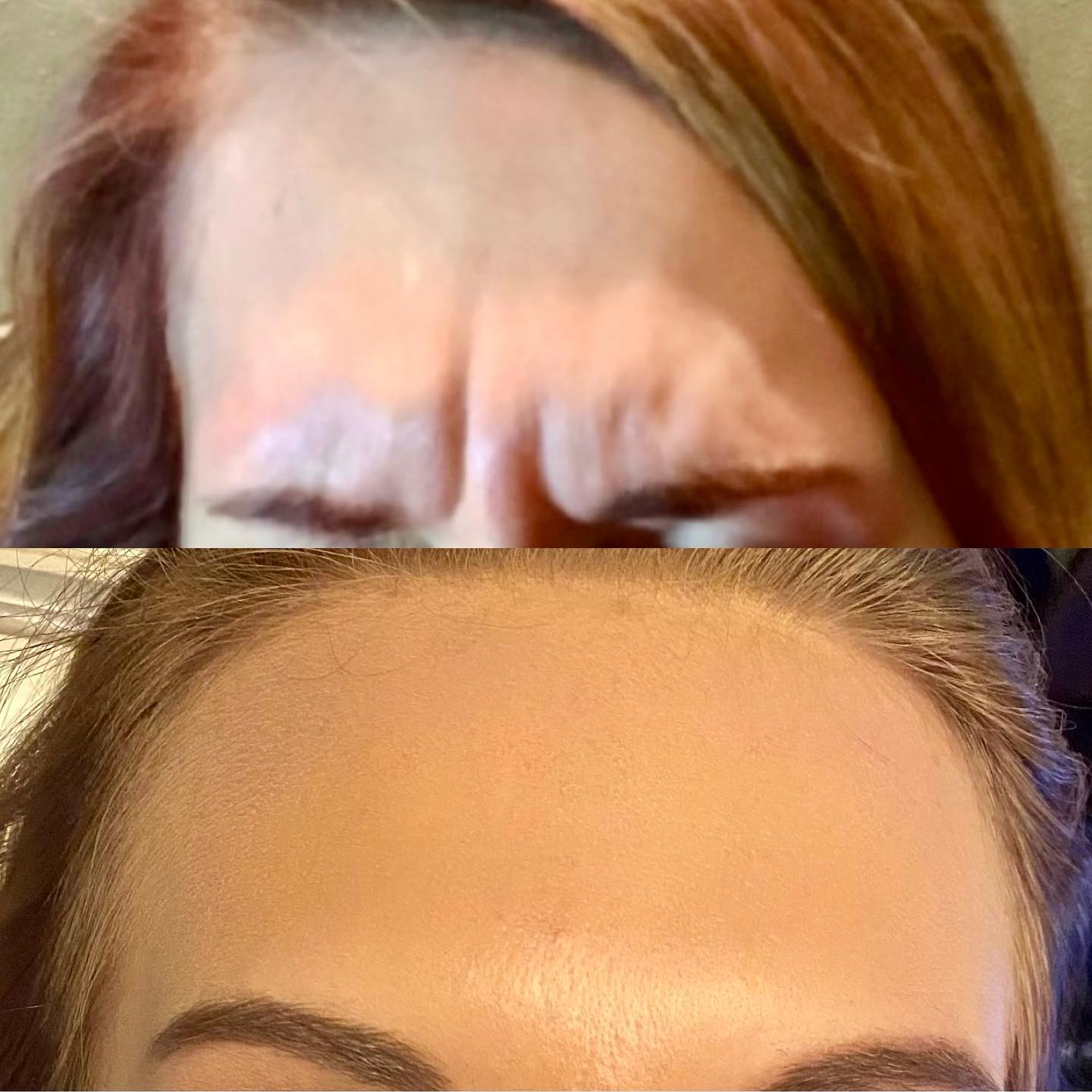 Forehead lines at Malory at Medispa