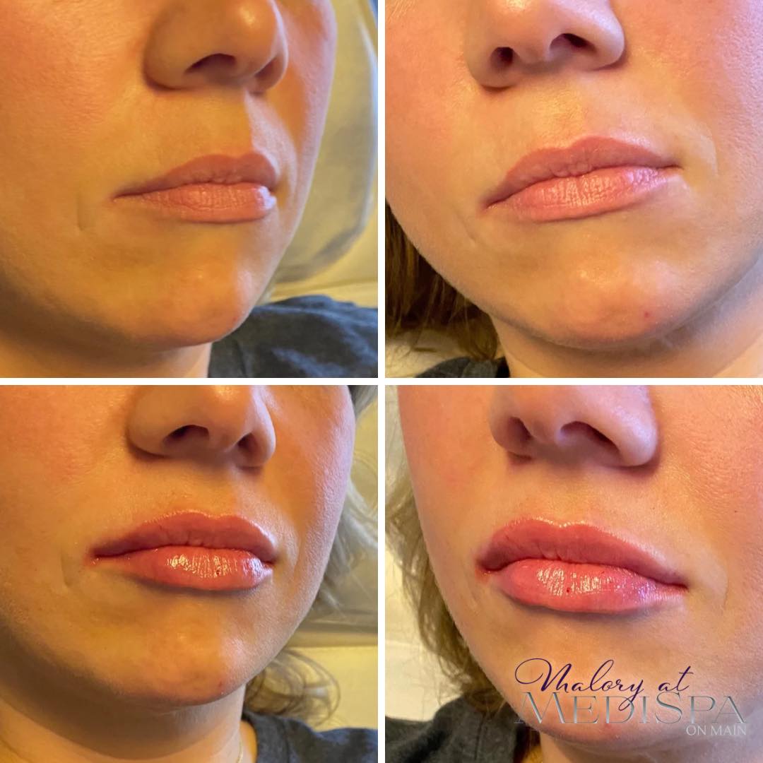 Lip injections at Malory at Medispa