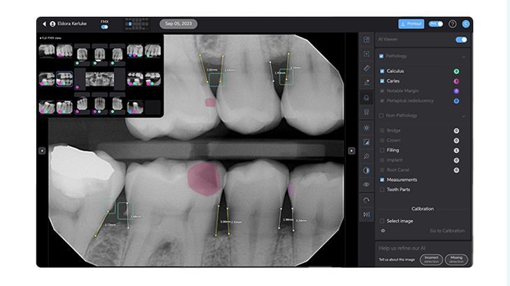Boy in glasses smiles widely in a dental chair, facing a person out of frame.