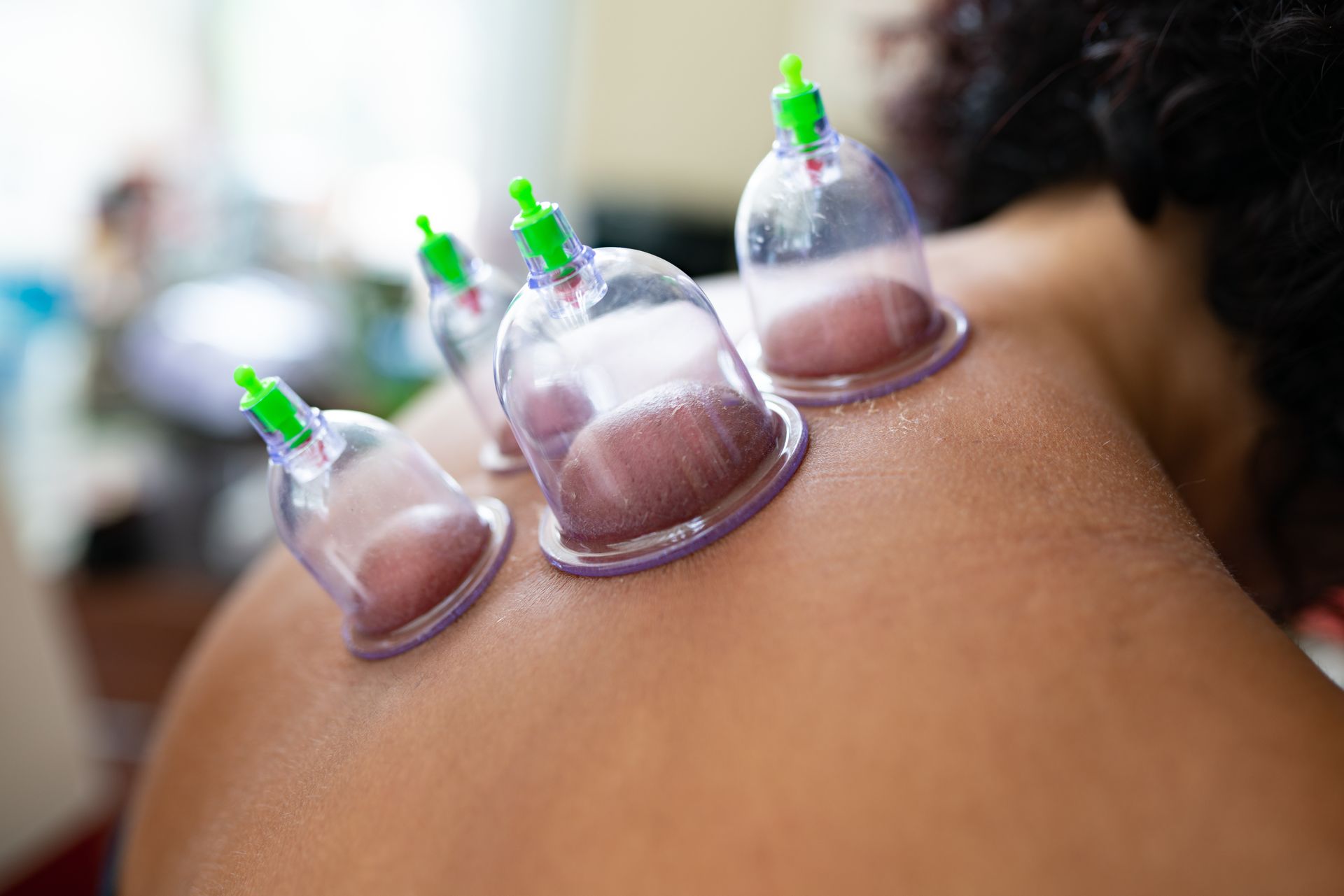 Clear suction cups on a person's shoulder, reddish marks visible inside the cups.