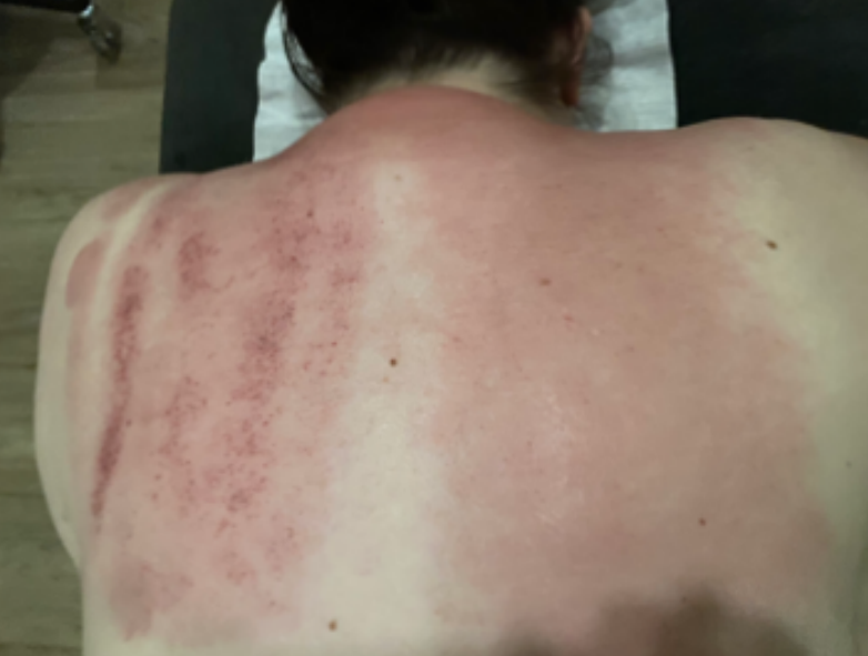 a woman is laying on a bed with a red spot on her back