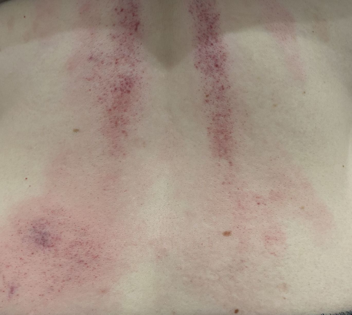 a close up of a person 's back with red spots on it