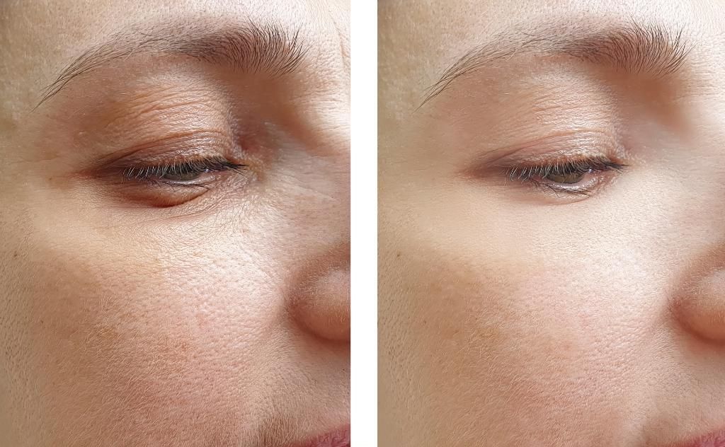 Benefits of Under-Eye Filler Treatment