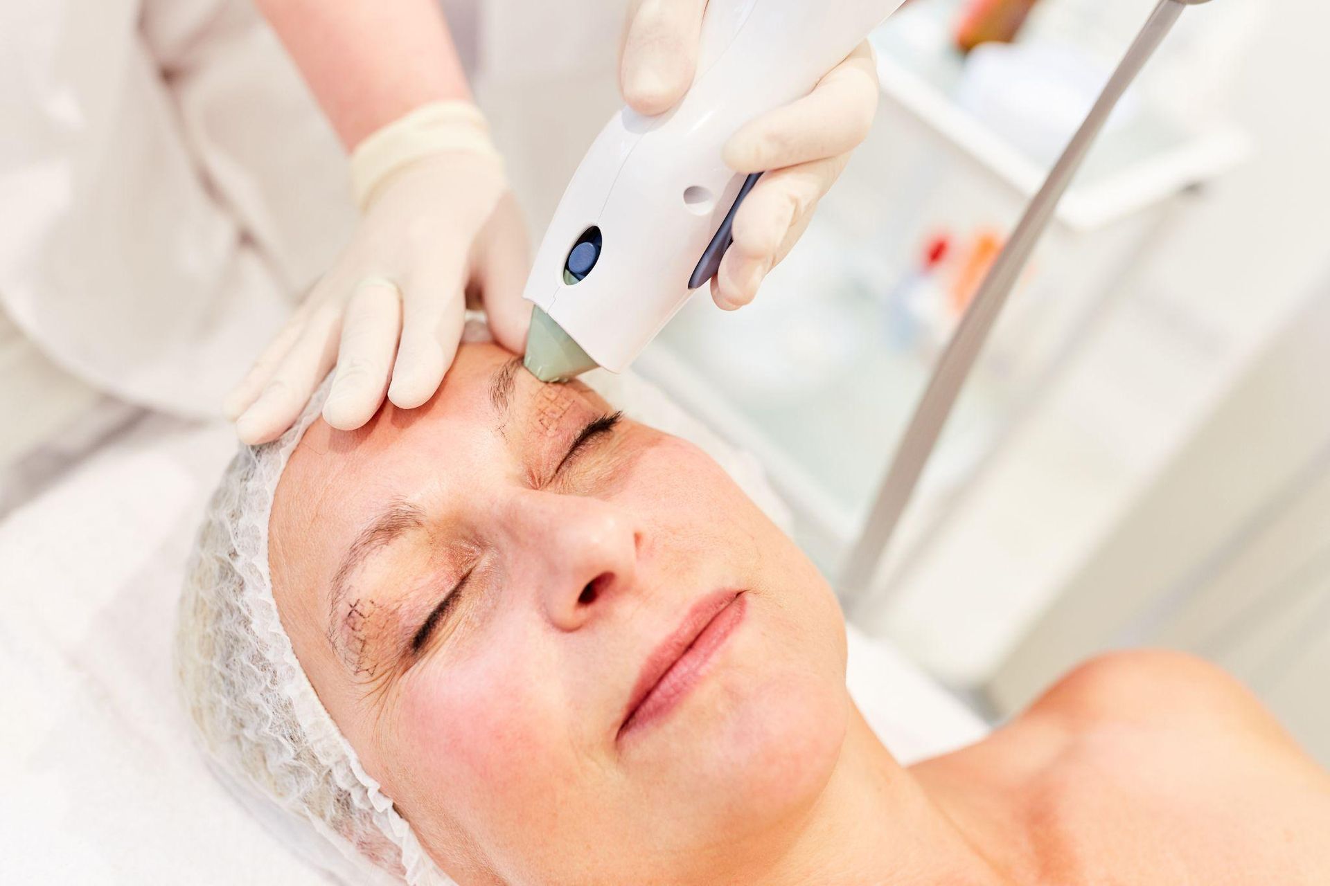 Ways Thermage Enhances Your Skin