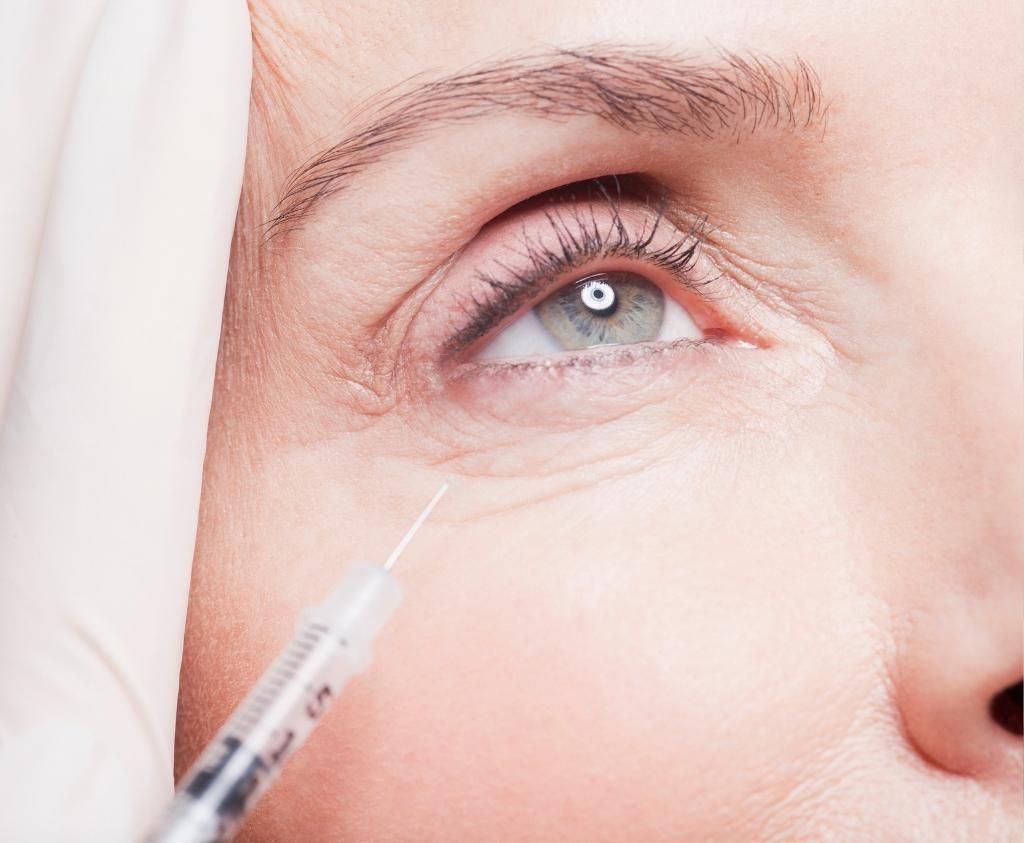 What Are Under-Eye Dermal Fillers