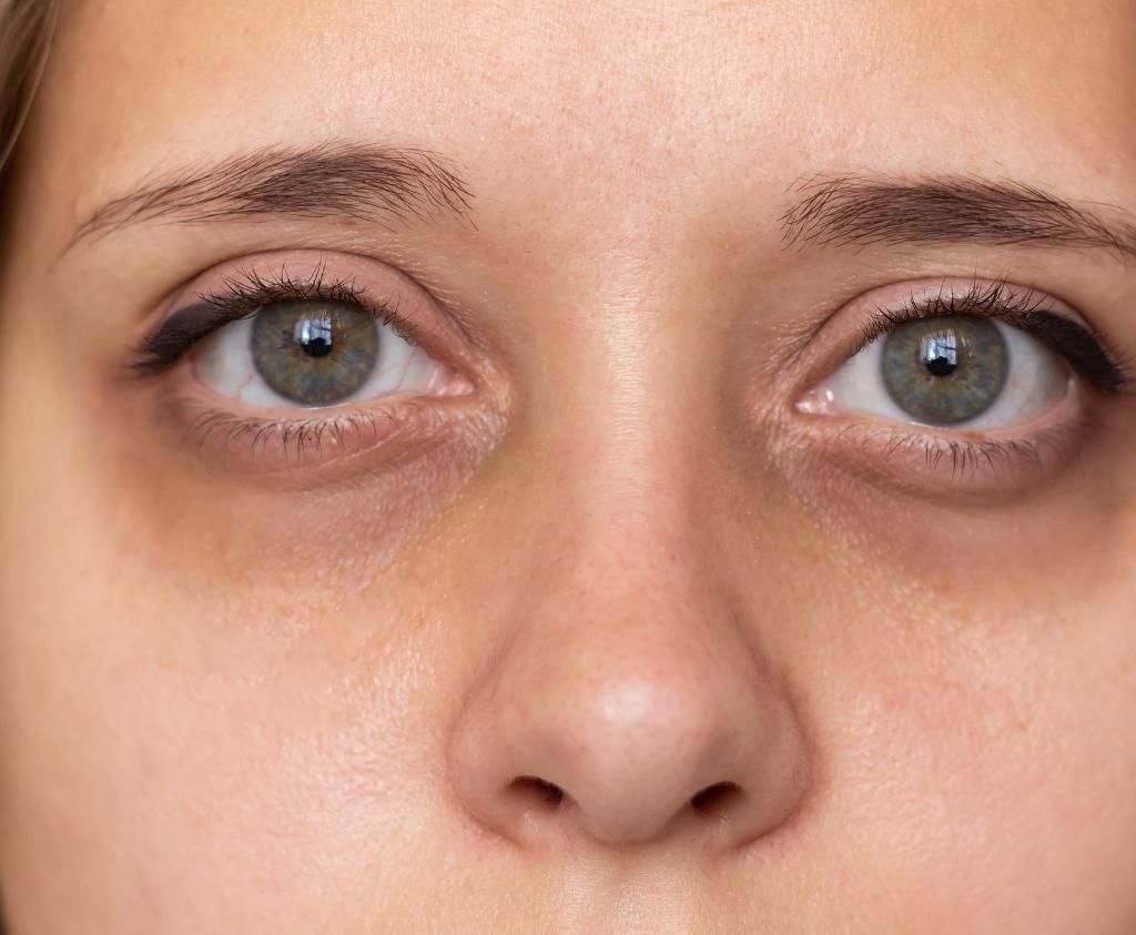 Why the Under-Eye Area Changes First