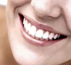dental veneers cosmetic dentist in Norwood