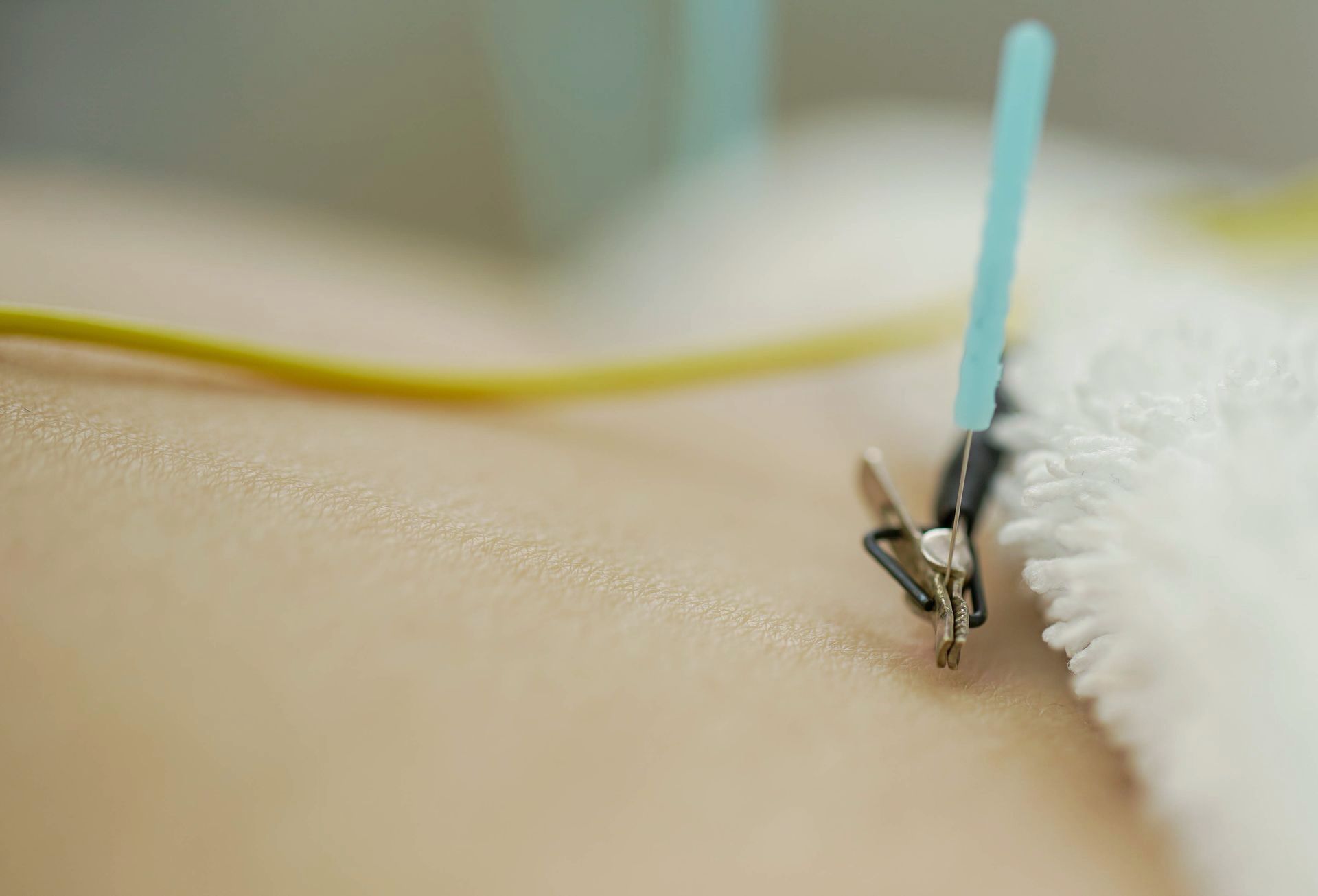 a close up of an acupuncture needle on a person 's back