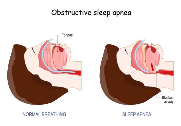 What is Obstructive Sleep Apnea and Why Should You Care?