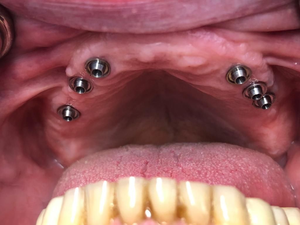 Un primo piano della bocca di una persona sequenza impianto di implantologia