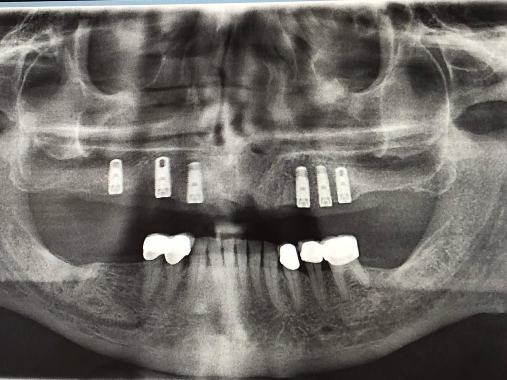 Una radiografia panoramica dei denti - Un primo piano della bocca di una persona sequenza impianto di implantologia