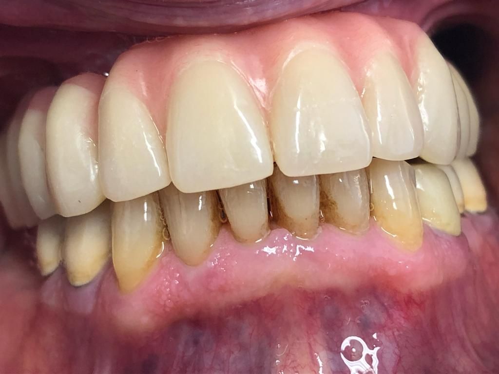 Un primo piano della bocca di una persona sequenza impianto di implantologia