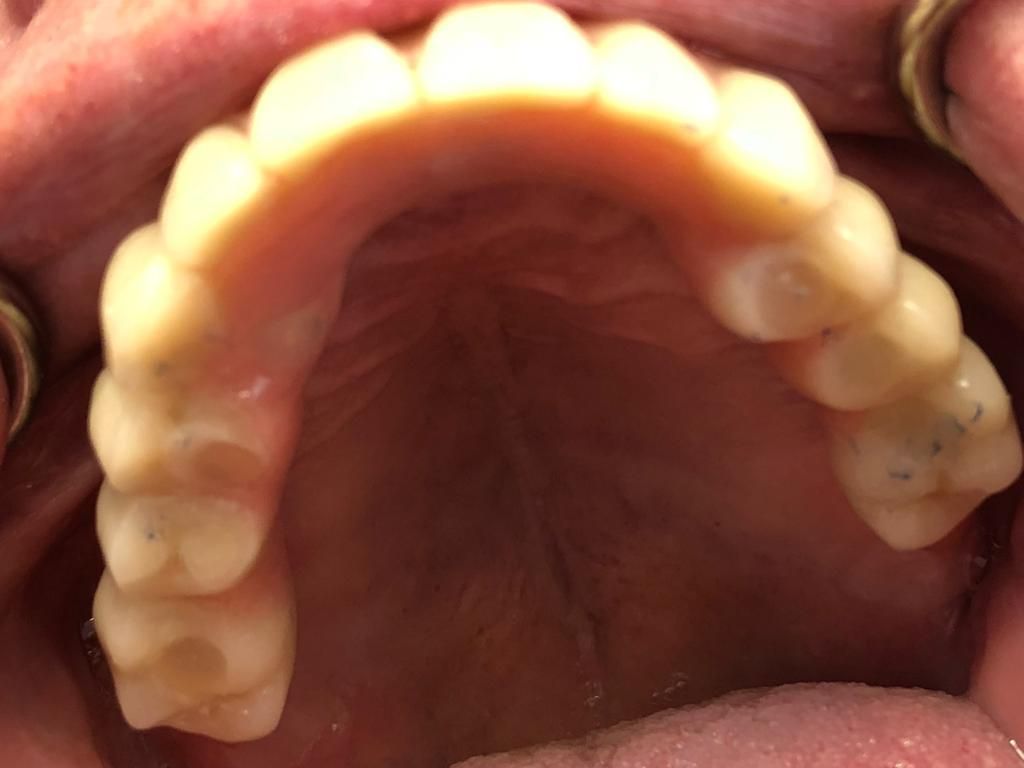 Un primo piano della bocca di una persona sequenza impianto di implantologia