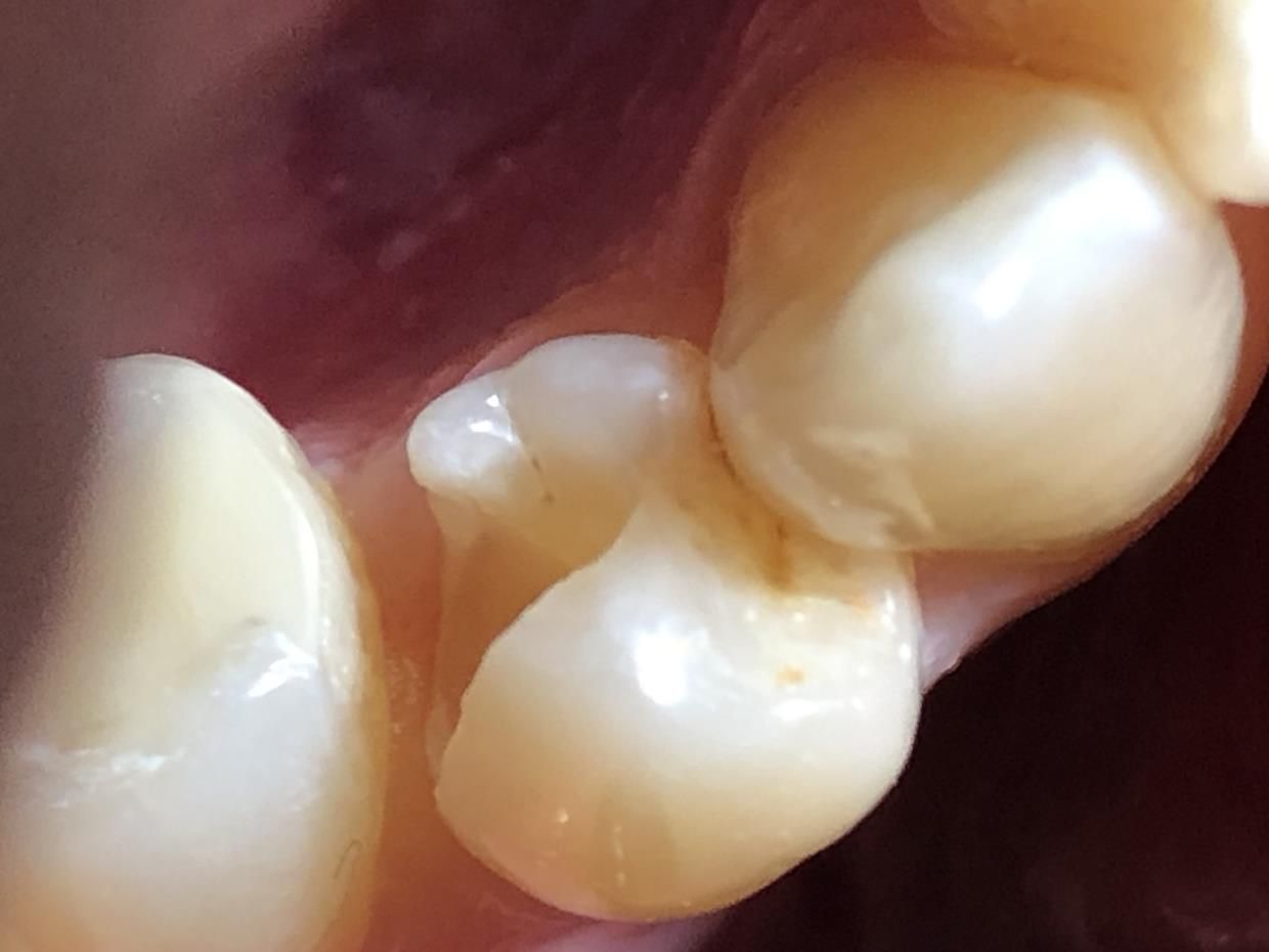 Un primo piano dei denti - trattamenti conservativa