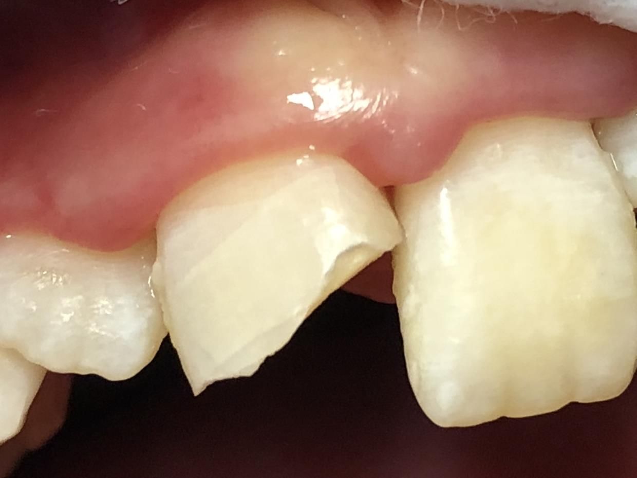 Un primo piano dei denti - trattamenti conservativa