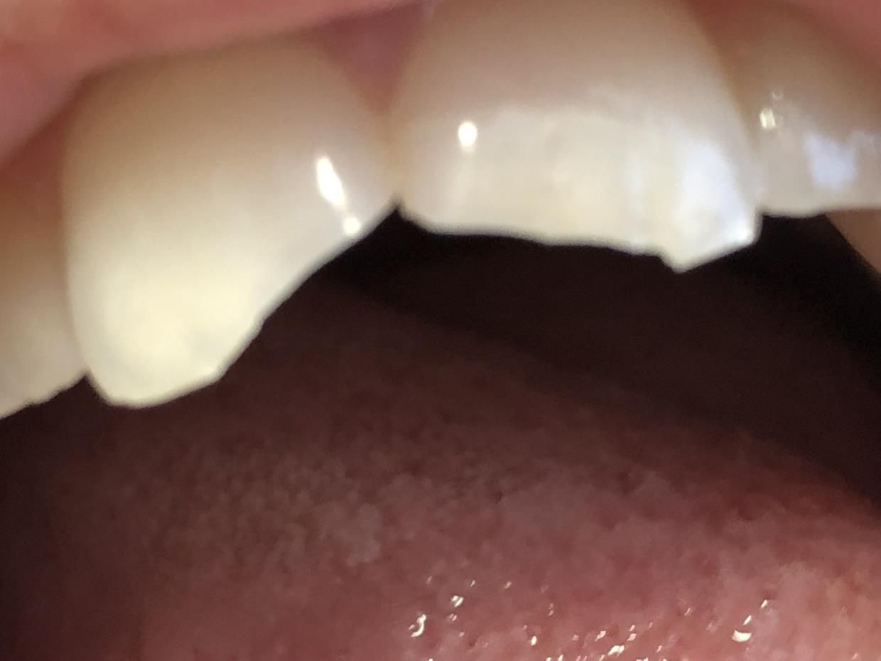 Un primo piano dei denti - trattamenti conservativa