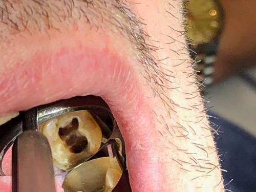 Un primo piano della bocca endodonzia