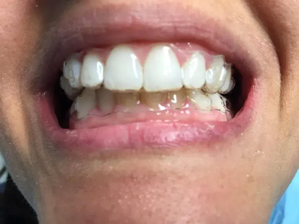 bocca in primo piano - ortodonzia