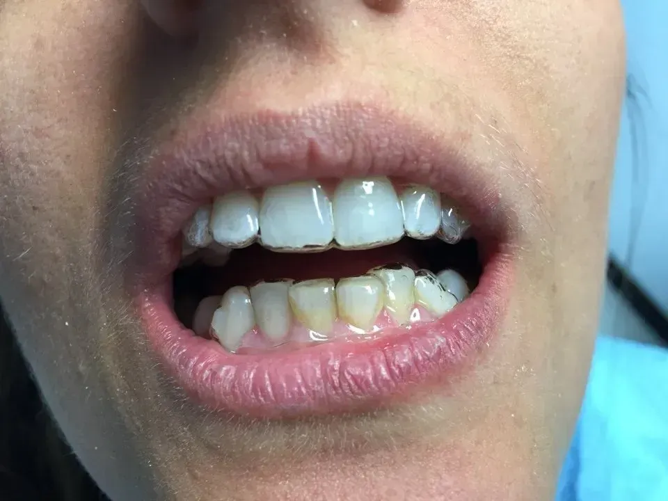 bocca in primo piano - ortodonzia