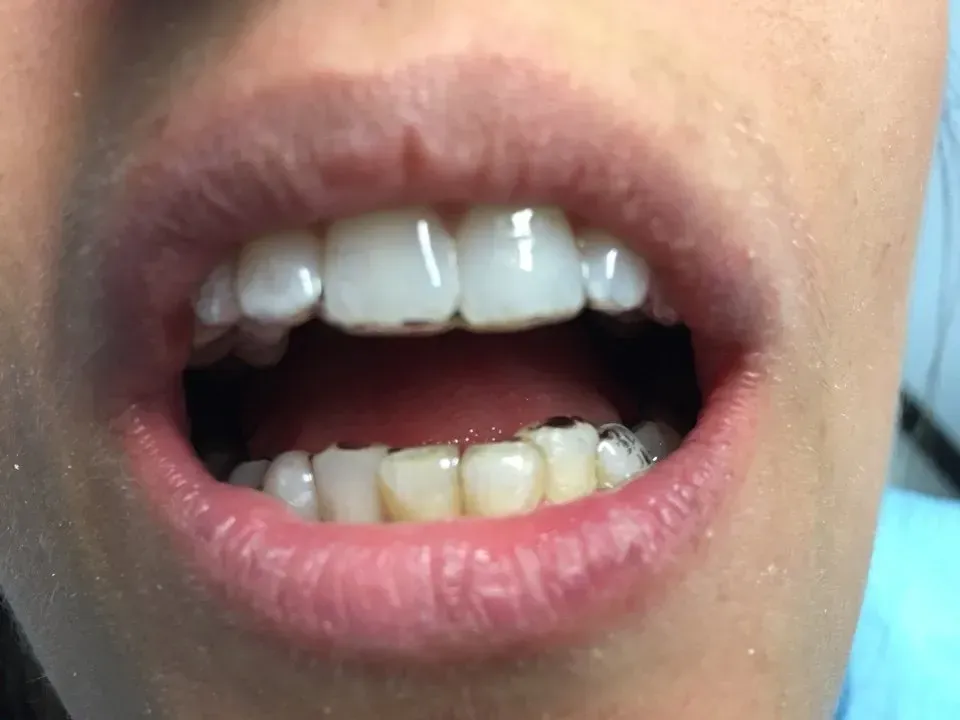 bocca in primo piano - ortodonzia