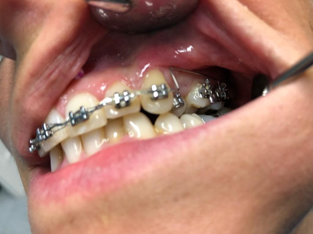 bocca in primo piano - ortodonzia