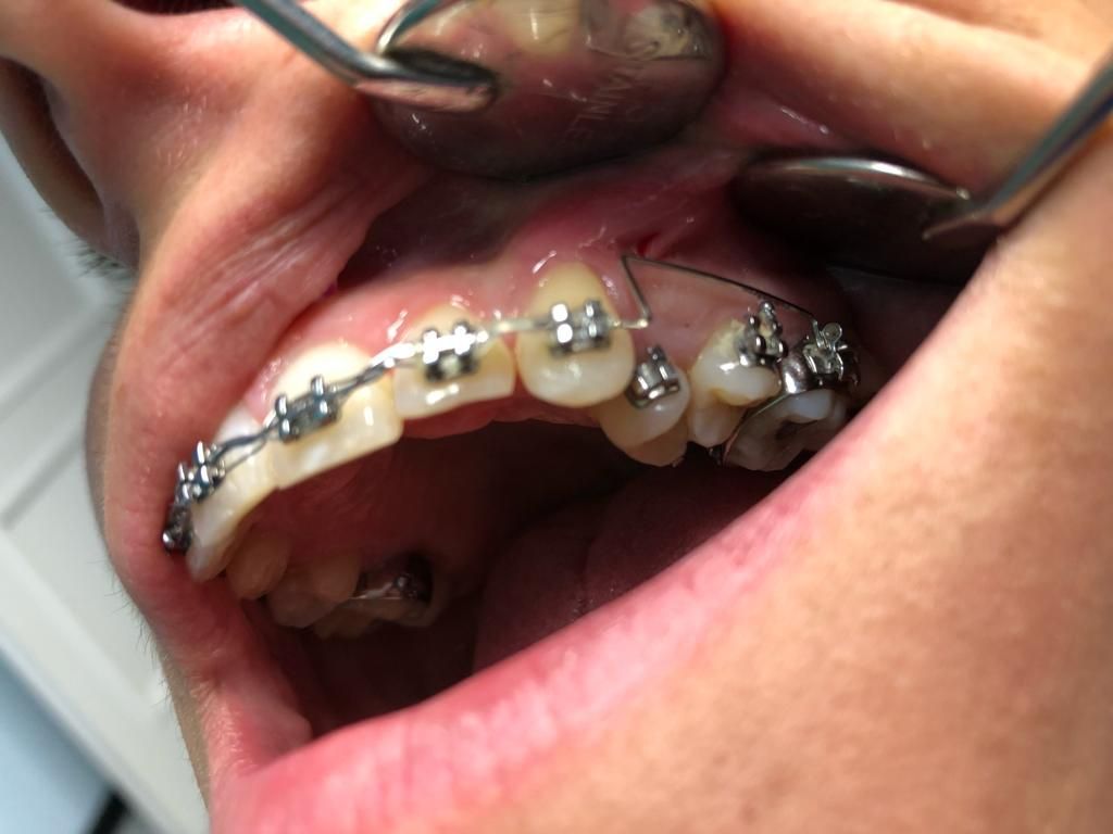 bocca in primo piano - ortodonzia