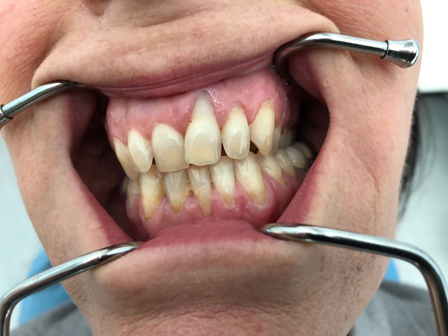 Un primo piano della bocca di una persona - paradontologia