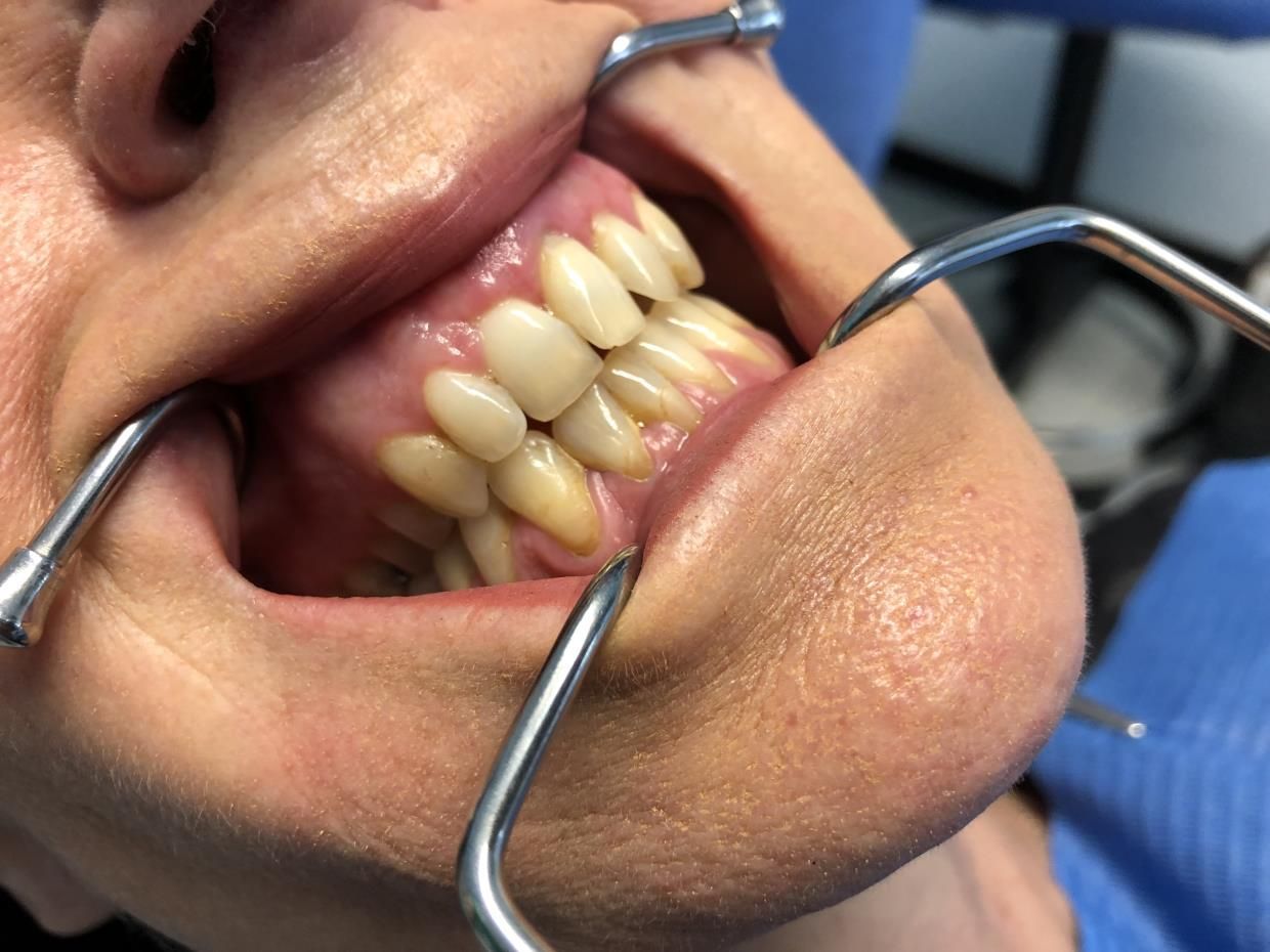 Un primo piano della bocca di una persona - paradontologia