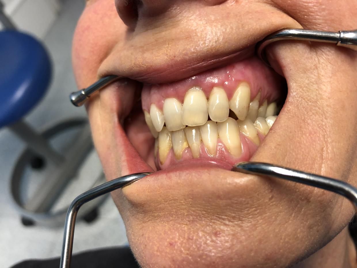 Un primo piano della bocca di una persona - paradontologia